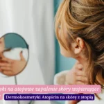 Kosmetyki na atopowe zapalenie skóry