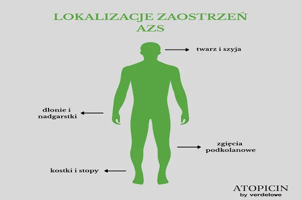 W jakich miejscach na ciele występują zaostrzenia AZS