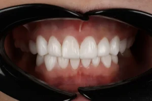 Bonding czy licówki? Sprawdź, co jest lepszym wyborem dla Twojego uśmiechu