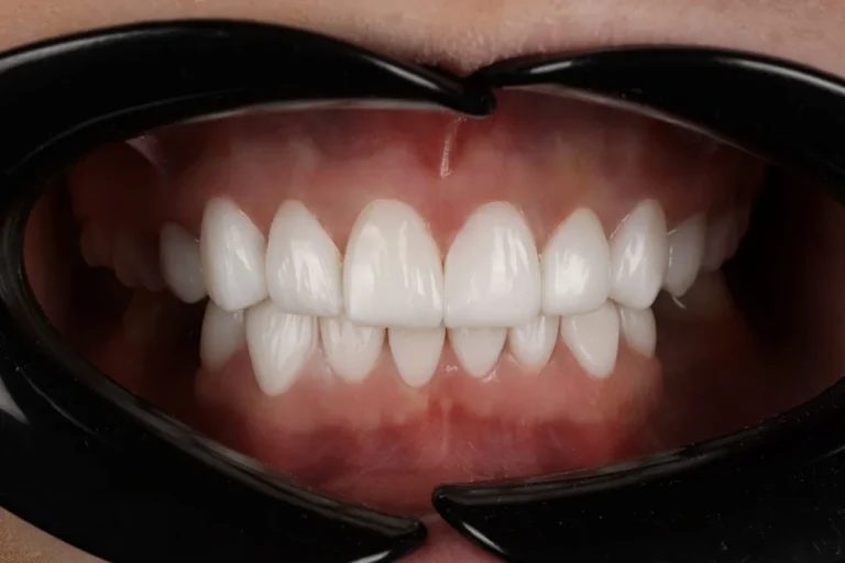 Bonding czy licówki? Sprawdź, co jest lepszym wyborem dla Twojego uśmiechu