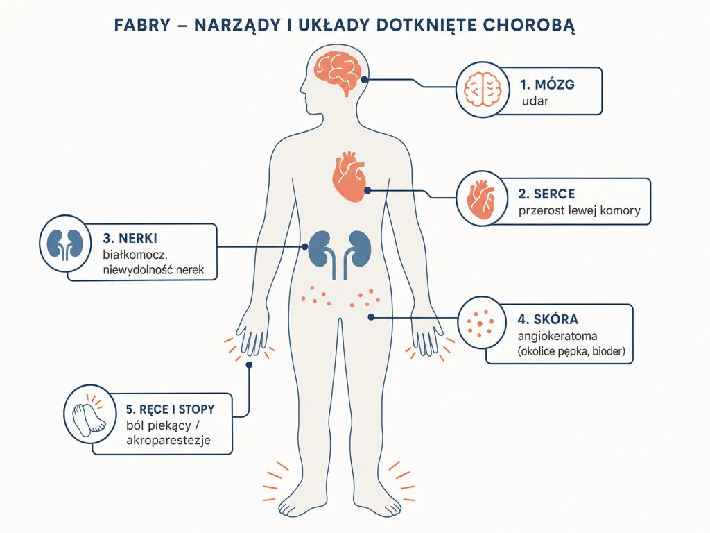 Infografika przedstawiająca narządy i układy dotknięte chorobą Fabry'ego: dłonie i stopy, nerki, serce, skóra, mózg