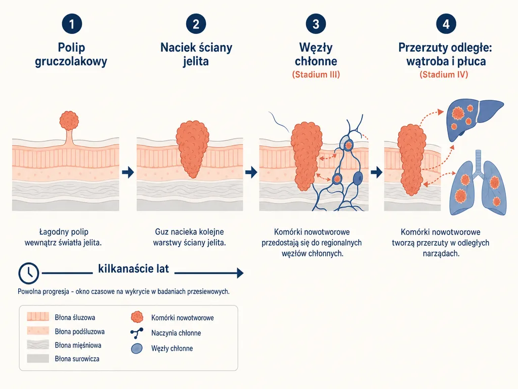 Diagram progresji raka jelita grubego od polipa gruczolakowego przez zajęcie węzłów chłonnych do przerzutów odległych