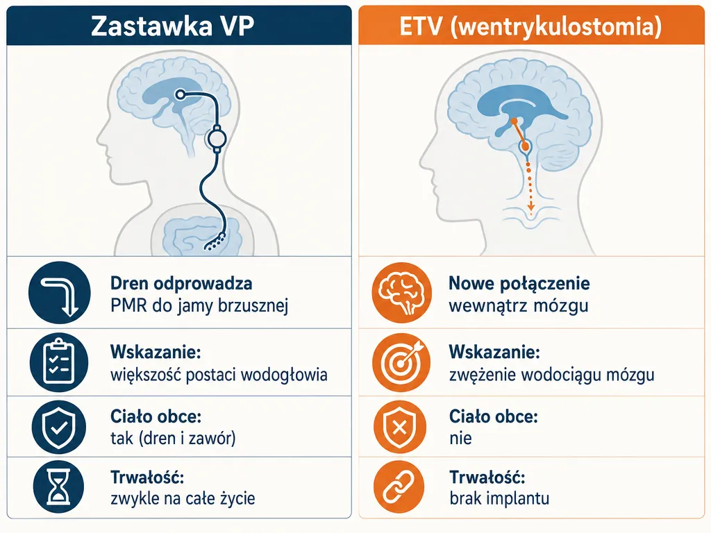 Infografika porównująca dwie metody leczenia wodogłowia: zastawka komorowo-otrzewnowa VP oraz endoskopowa wentrykulostomia ETV